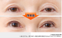 左右非対称なまぶたも